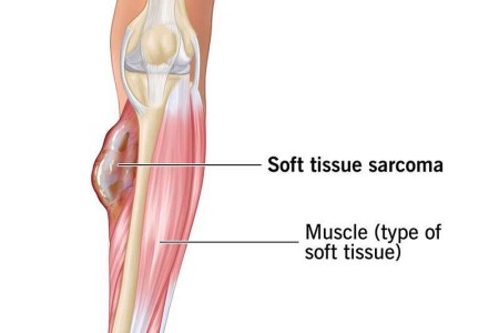Soft Tissue Sarcoma