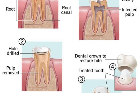 Root Canal