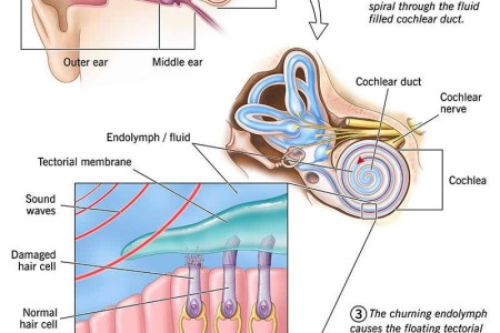 Noise-Induced Hearing Loss (NIHL)
