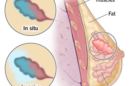 Lobular Carcinoma in Situ (LCIS)