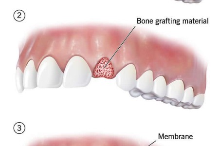 Dental Bone Graft