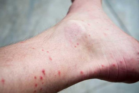 Flea Bites