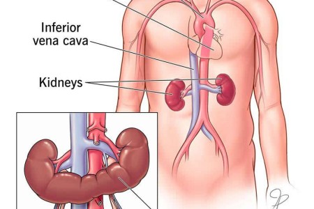 Horseshoe Kidney