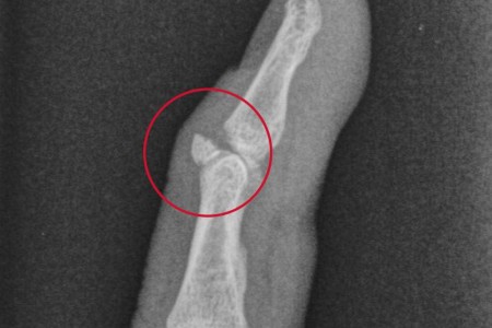 Avulsion Fracture