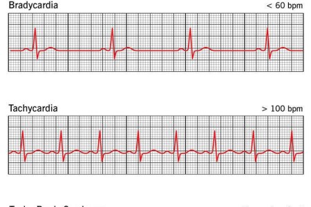Sick Sinus Syndrome