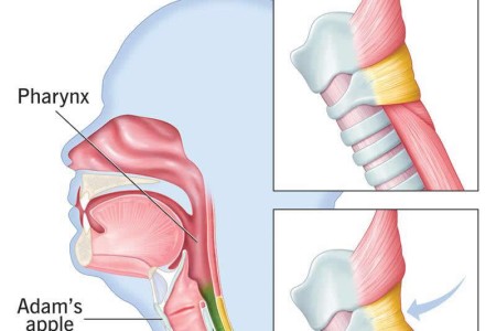 Cricopharyngeal Spasm