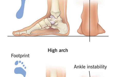High Arch Feet (Pes Cavus)