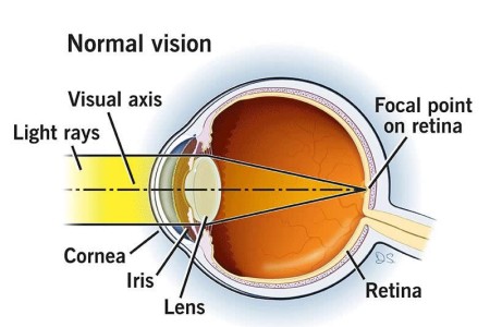 LASIK Eye Surgery