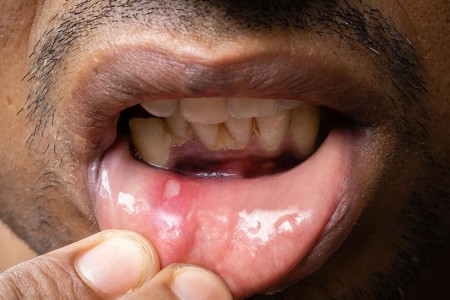 Mouth Ulcer