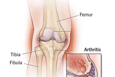 Knee Osteoarthritis