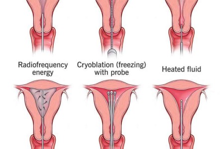 Endometrial Ablation
