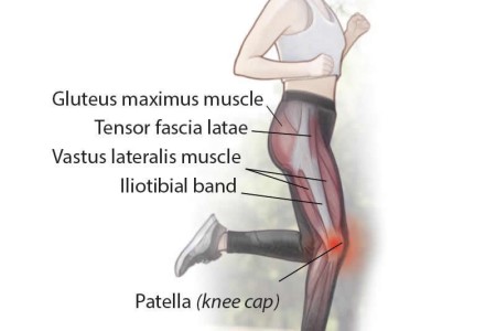 Iliotibial Band Syndrome