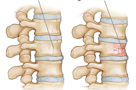 Compression Fractures