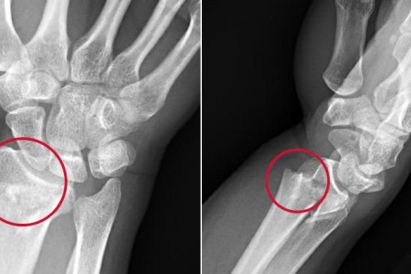 Colles Fracture