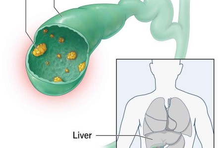Gallbladder Polyps