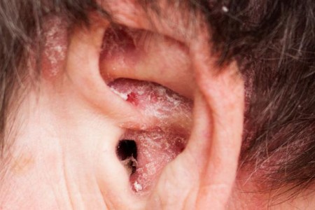 Ear Eczema