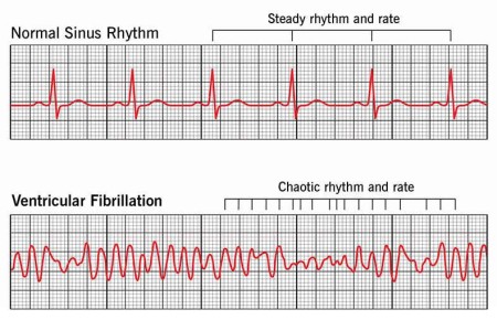 Ventricular Fibrillation