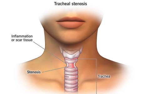 Tracheal Stenosis