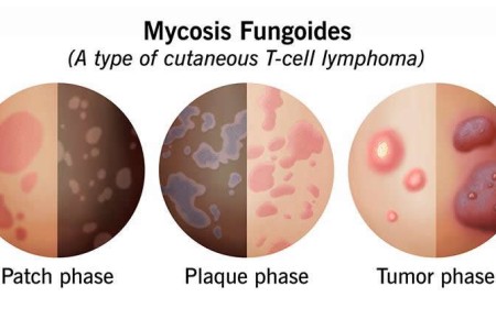 Mycosis Fungoides