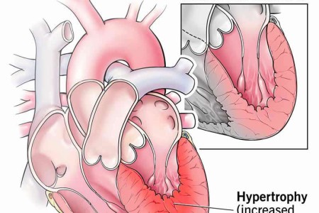 Left Ventricular Hypertrophy