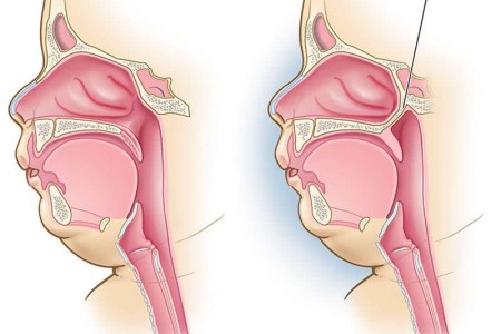 Choanal Atresia