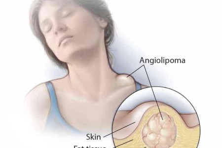 Angiolipoma