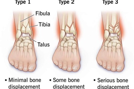 Pilon Fracture (Tibial Plafond Fracture)