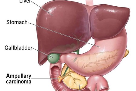 Ampullary Cancer