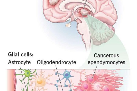 Glioma