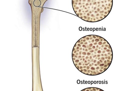 Osteopenia