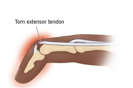 Mallet Finger