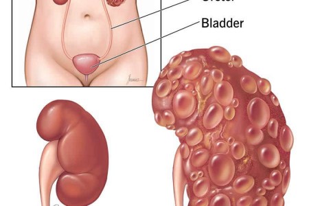 Cystic Kidney Disease