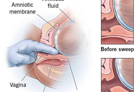 Membrane Sweep