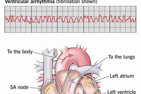 Ventricular Arrhythmia