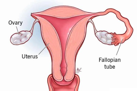 Salpingectomy