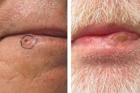 Lip Cancer