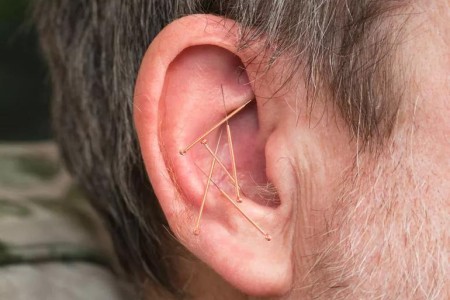 Can NADA Acupuncture Help With Addiction and Trauma?