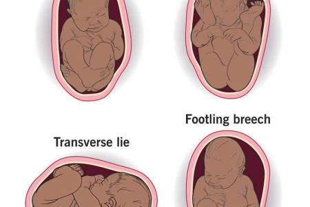 Breech Baby