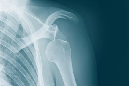 What’s the Difference Between Shoulder Dislocation and Subluxation?