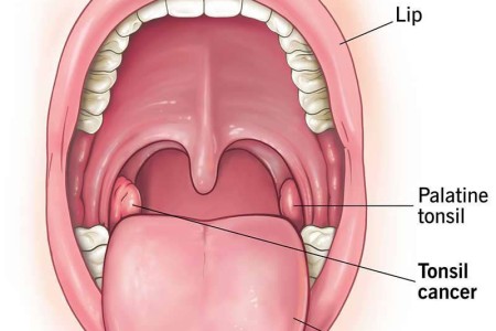 Tonsil Cancer
