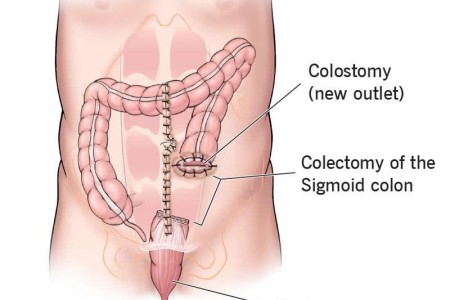 Hartmann’s Procedure