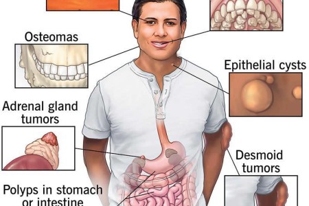 Gardner Syndrome