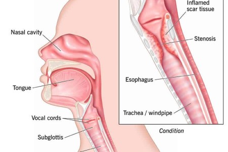 Subglottic Stenosis