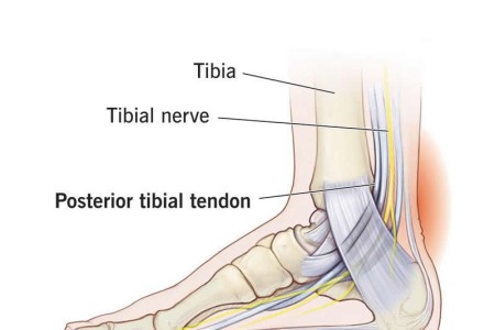Posterior Tibial Tendonitis and Posterior Tibial Tendon Dysfunction