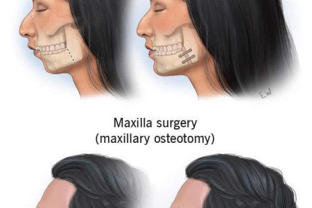 Jaw Surgery