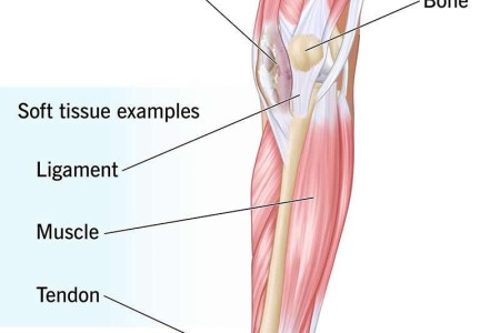 Synovial Sarcoma