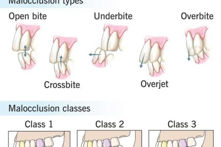 Malocclusion