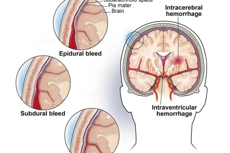 Epidural Hematoma