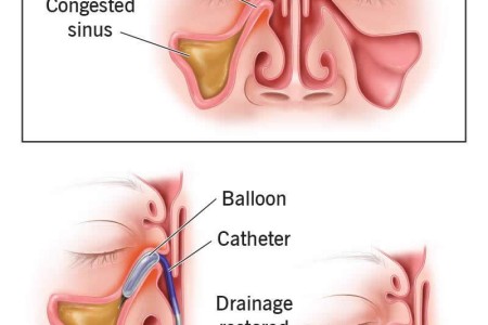 Balloon Sinuplasty
