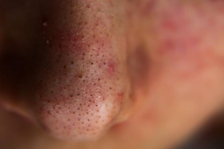 Blackheads